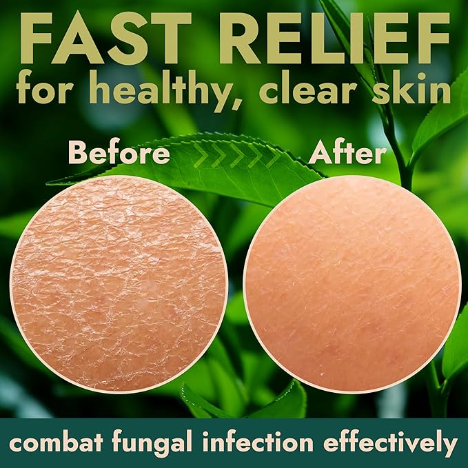 Antifungal Soap | Deep-Cleansing & Exfoliating Bar for Men & Women | Natural Ingredients with Tea Tree & Eucalyptus | Helps Soothe Jock Itch, Ringworm & Athlete’s Foot Pumice Bar Soap